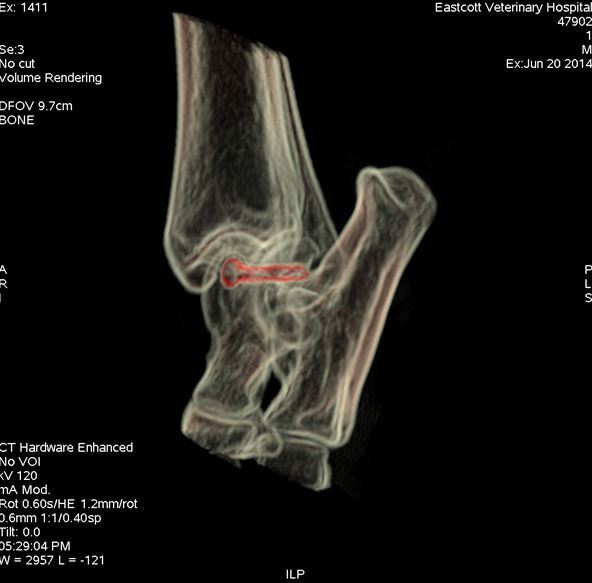 Post-operative CT scan showing position of screw (red) stabilising medial talar ridge fracture